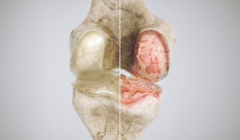 Osteoartritiš koljena iz perspektive ortopeda